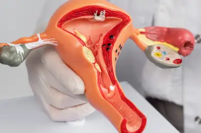 Cirugía para cancer de endometrio